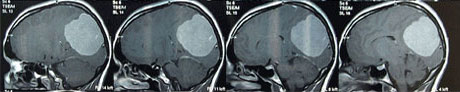 CT-Aufnahmen Gehirntumor