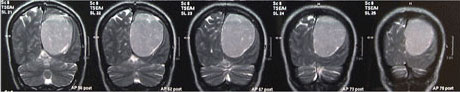 CT-Aufnahmen Gehirntumor